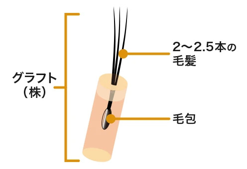 自毛植毛の費用