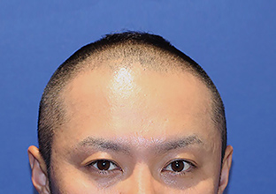 30代T.Mさん 施術前