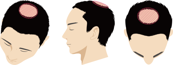 Ⅵ型