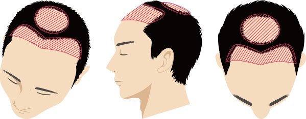 Ⅵ型