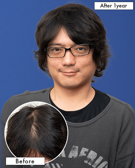 40代 男性 I.Mさんの上半身写真（施術後）