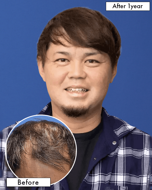 30代 男性 O.Sさんの上半身写真（施術後）