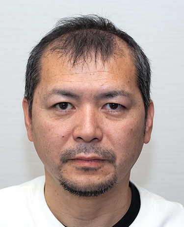 40代 男性 H.Tさんの顔写真（術前）
