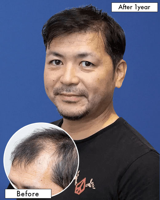 男性 H.Tさんの上半身写真（施術後）