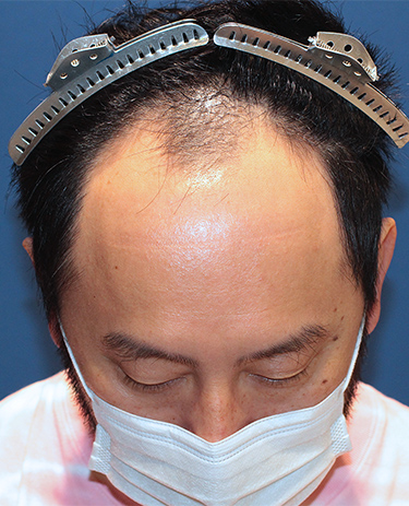 40代男性Y.Tさんの顔写真（施術前）