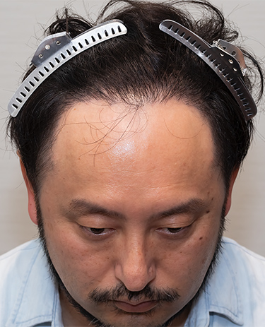 40代男性Y.Tさんの顔写真（施術後）