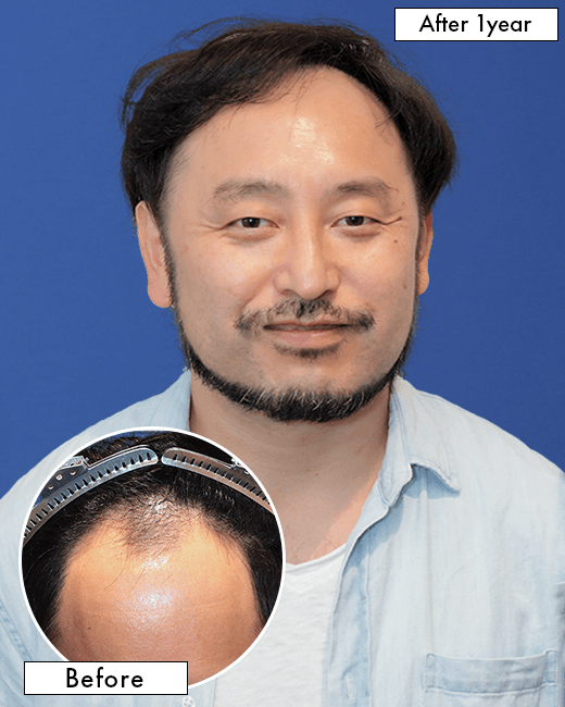 40代男性Y.Tさんの上半身写真（施術後）