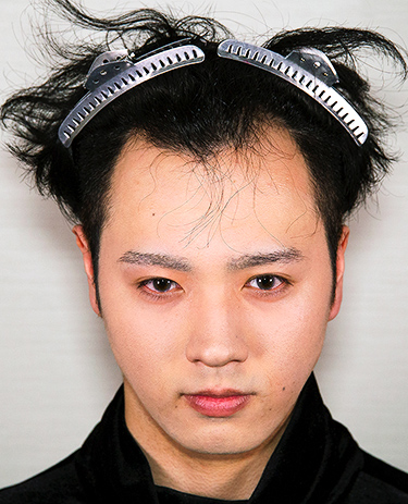 20代 男性 Y.Tさんの顔写真（施術前）