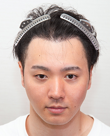 20代 男性 Y.Tさんの顔写真（1年4ヶ月後）