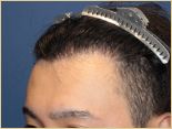 20代 男性 Y.Tさんの頭部写真1（1年4ヶ月後）