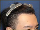 20代 男性 Y.Tさんの頭部写真3（1年4ヶ月後）