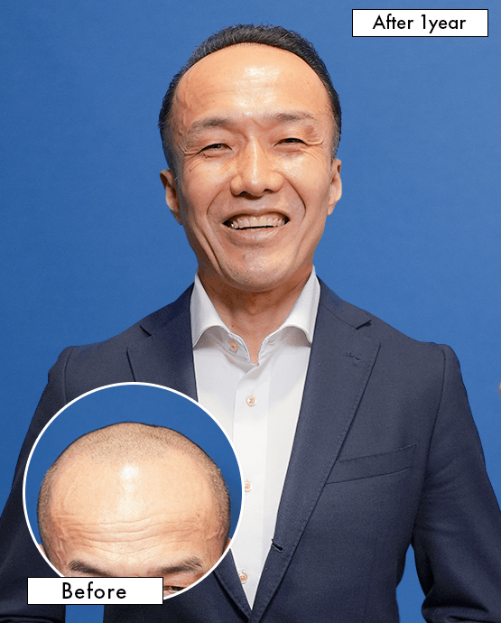 50代男性 Y.Tさんの上半身写真（施術後）