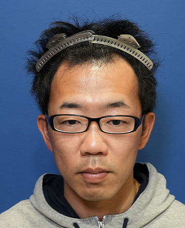 30代男性T.Wさんの顔写真（施術前）