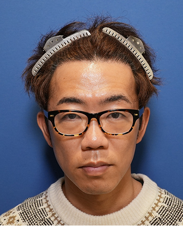 30代男性T.Wさんの顔写真（施術後）
