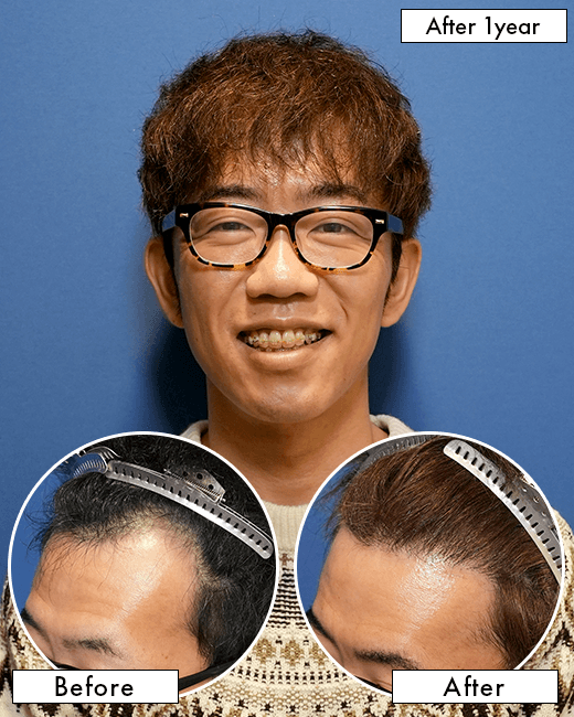 30代男性T.Wさんの上半身写真（施術後）