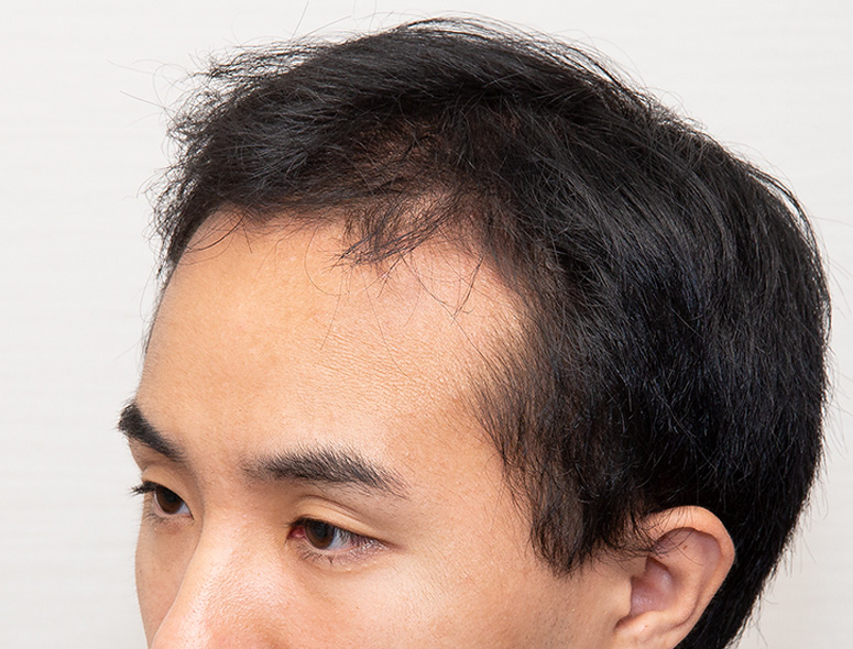 30代 男性 K.Hさんの頭部写真1（施術前）