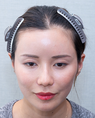 女性F.Cさんの顔写真（施術前）