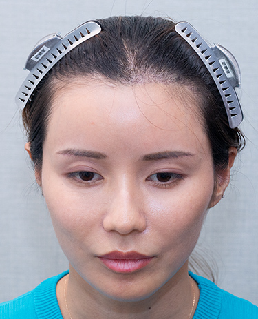 女性F.Cさんの顔写真（施術後）