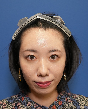 女性A.Mさんの顔写真（施術前）