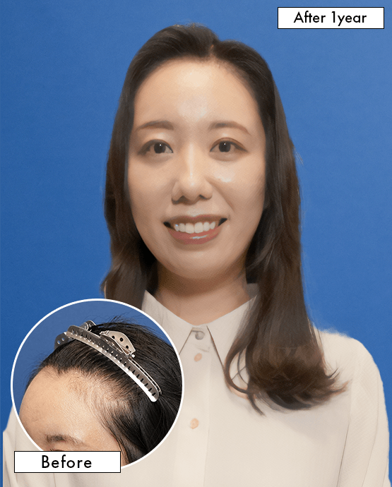 女性A.Mさんの上半身写真（施術後）