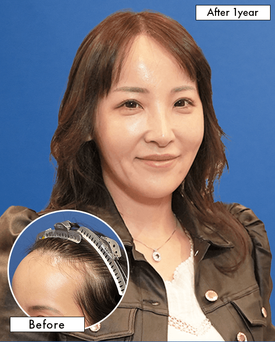 女性S.Mさんの上半身写真（施術後）