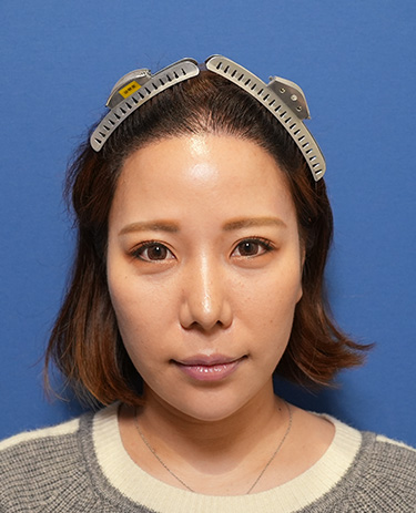 女性O.Mさんの顔写真（術後9か月）