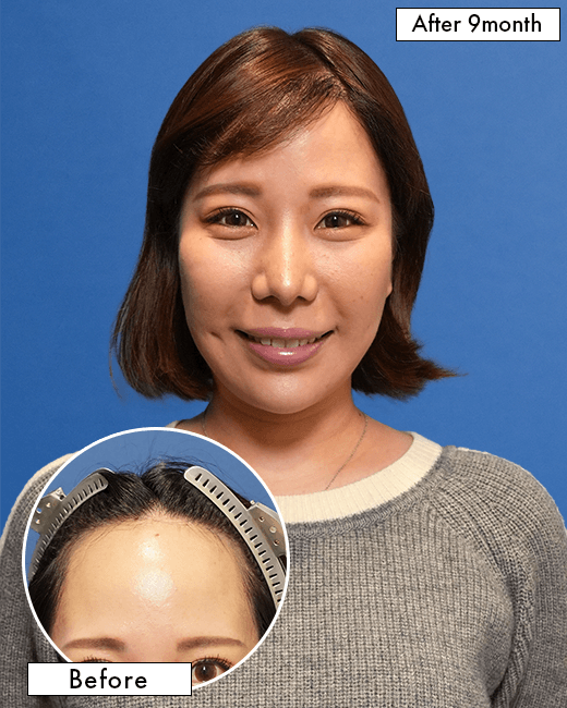 女性O.Mさんの上半身写真（施術後）