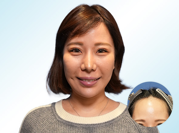 30代女性O.Mさんの上半身写真（施術後）＋施術前写真