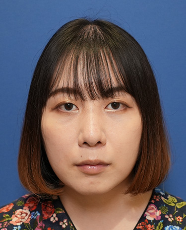 女性S.Hさんの顔写真（施術前）