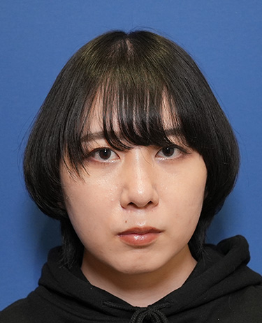 女性S.Hさんの顔写真（施術後）