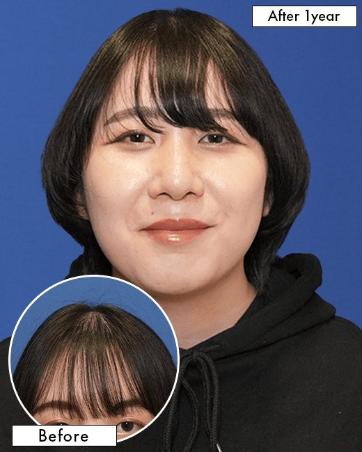 女性S.Hさんの顔写真（施術後）