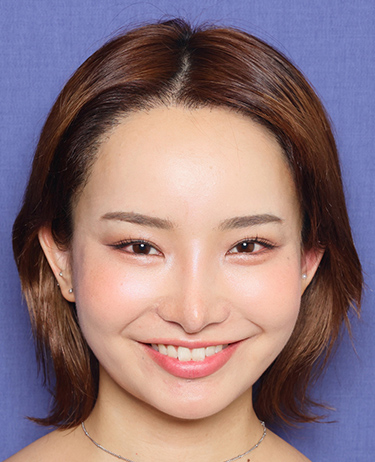 女性 梶山悠莉彩（yuria）さんの顔写真（術後1年）