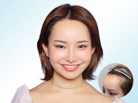 20代女性yuriaさんの上半身写真（施術後）＋施術前写真