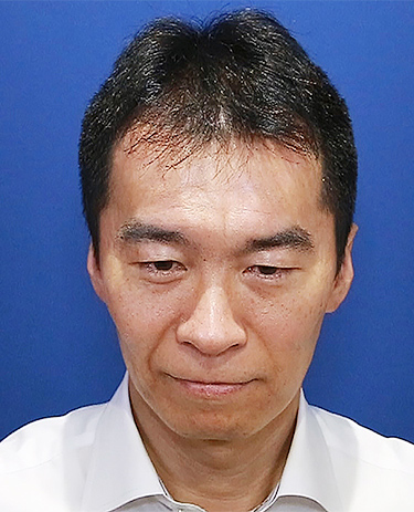 40代 男性 I.Kさんの顔写真（施術前）