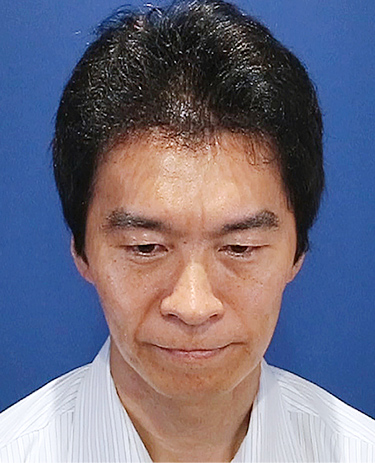 40代 男性 I.Kさんの顔写真（1年後）