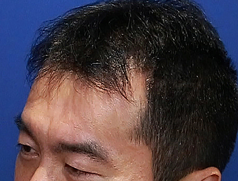 40代 男性 I.Kさんの頭部写真1（施術前）