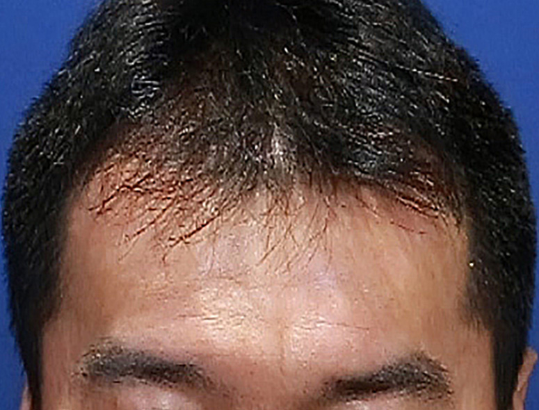 40代 男性 I.Kさんの頭部写真2（施術前）