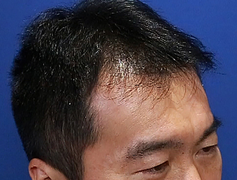 40代 男性 I.Kさんの頭部写真3（施術前）