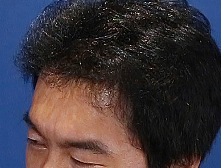 40代 男性 I.Kさんの頭部写真1（1年後）