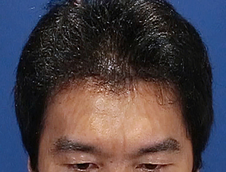 40代 男性 I.Kさんの頭部写真2（1年後）
