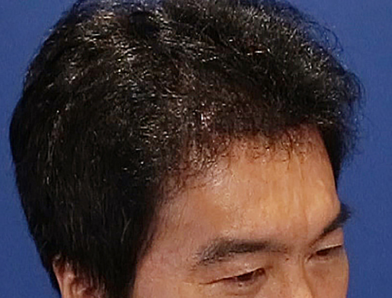 40代 男性 I.Kさんの頭部写真3（1年後）