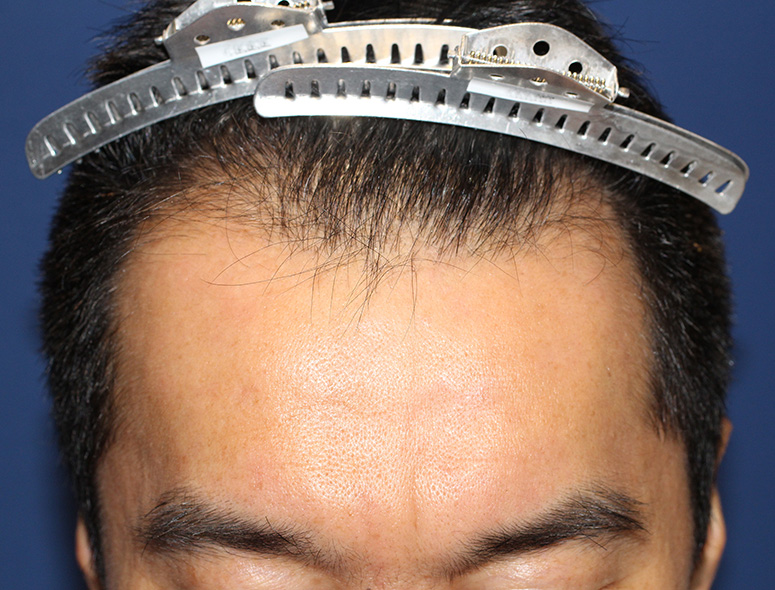 40代 男性 I.Kさんの頭部写真2（4年後）