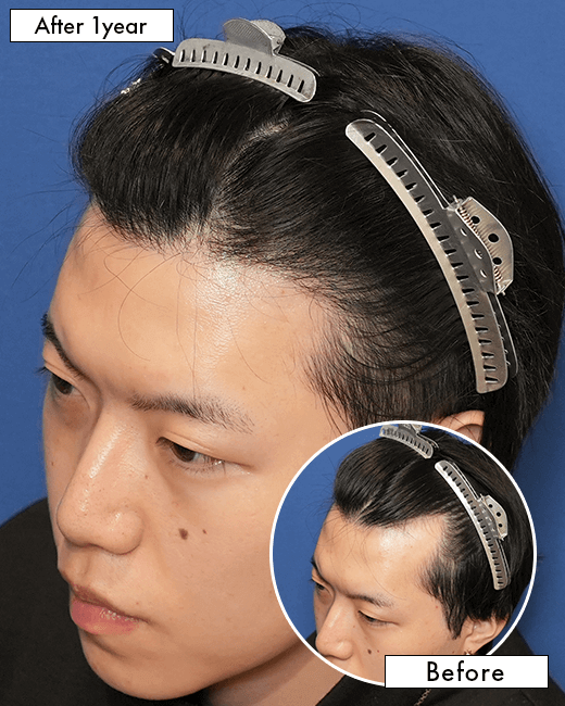 T.Rさんの上半身写真（施術後）