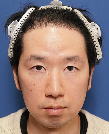 男性 Y.Dさんの顔写真（術後6ヶ月）