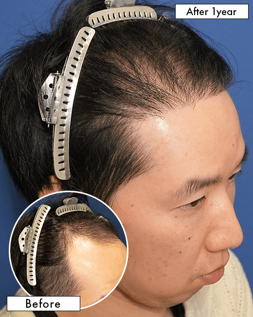 Y.Dさんの上半身写真（施術後）