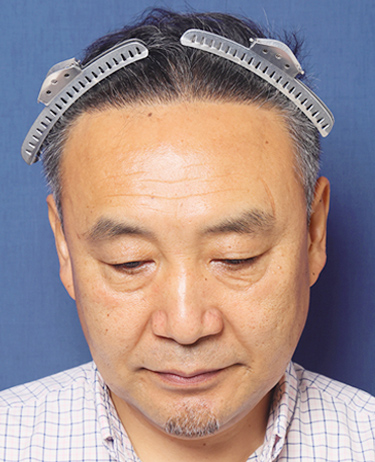 男性 S.Dさんの顔写真（術後）