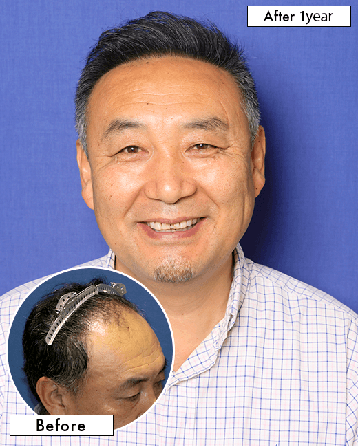 S.Dさんの上半身写真（施術後）