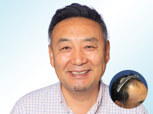 50代男性S.Dさんの上半身写真（施術後）＋施術前写真
