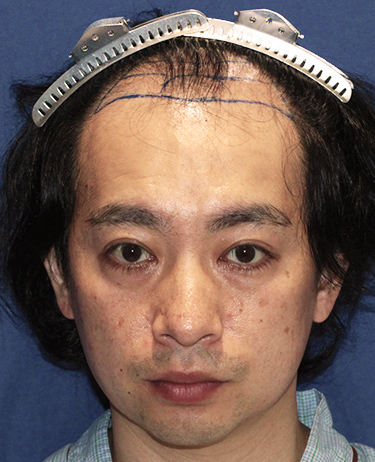 男性 S.Tさんの顔写真（施術前）