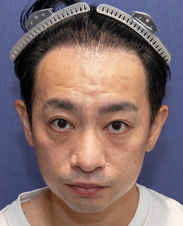 男性 S.Tさんの顔写真（術後1年）